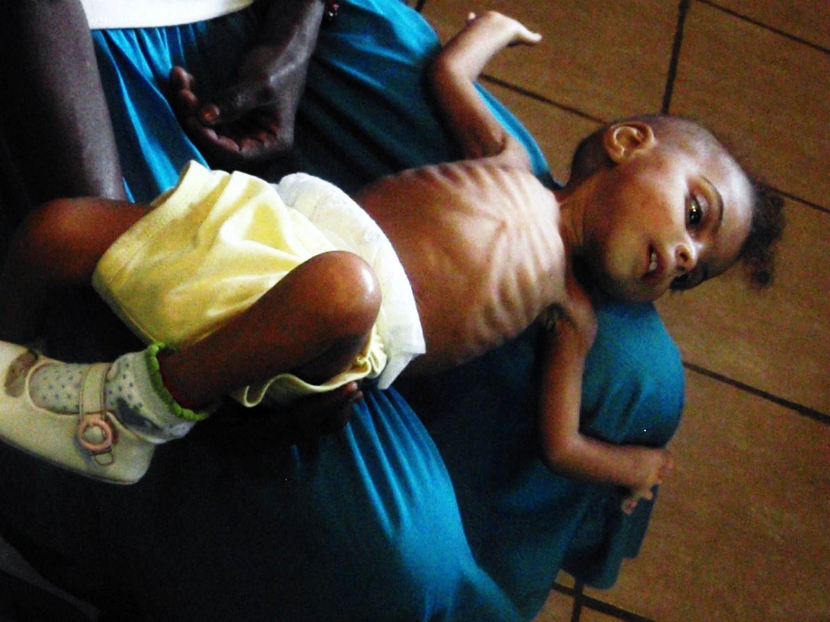 Patricia, a malnourished baby